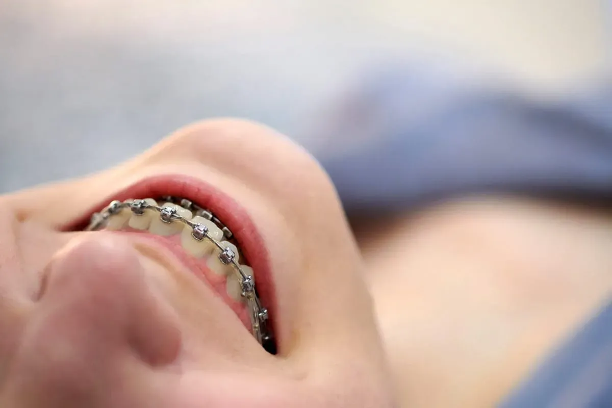 Traditional Braces: Benefits, Expectations, and Care