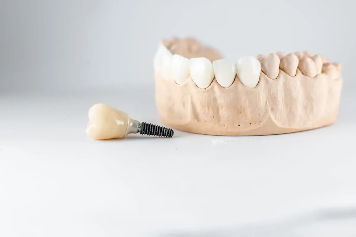 Dental Implants: Cost, Procedure, and Recovery Guide