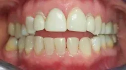 Smile with an open bite before Invisalign treatment